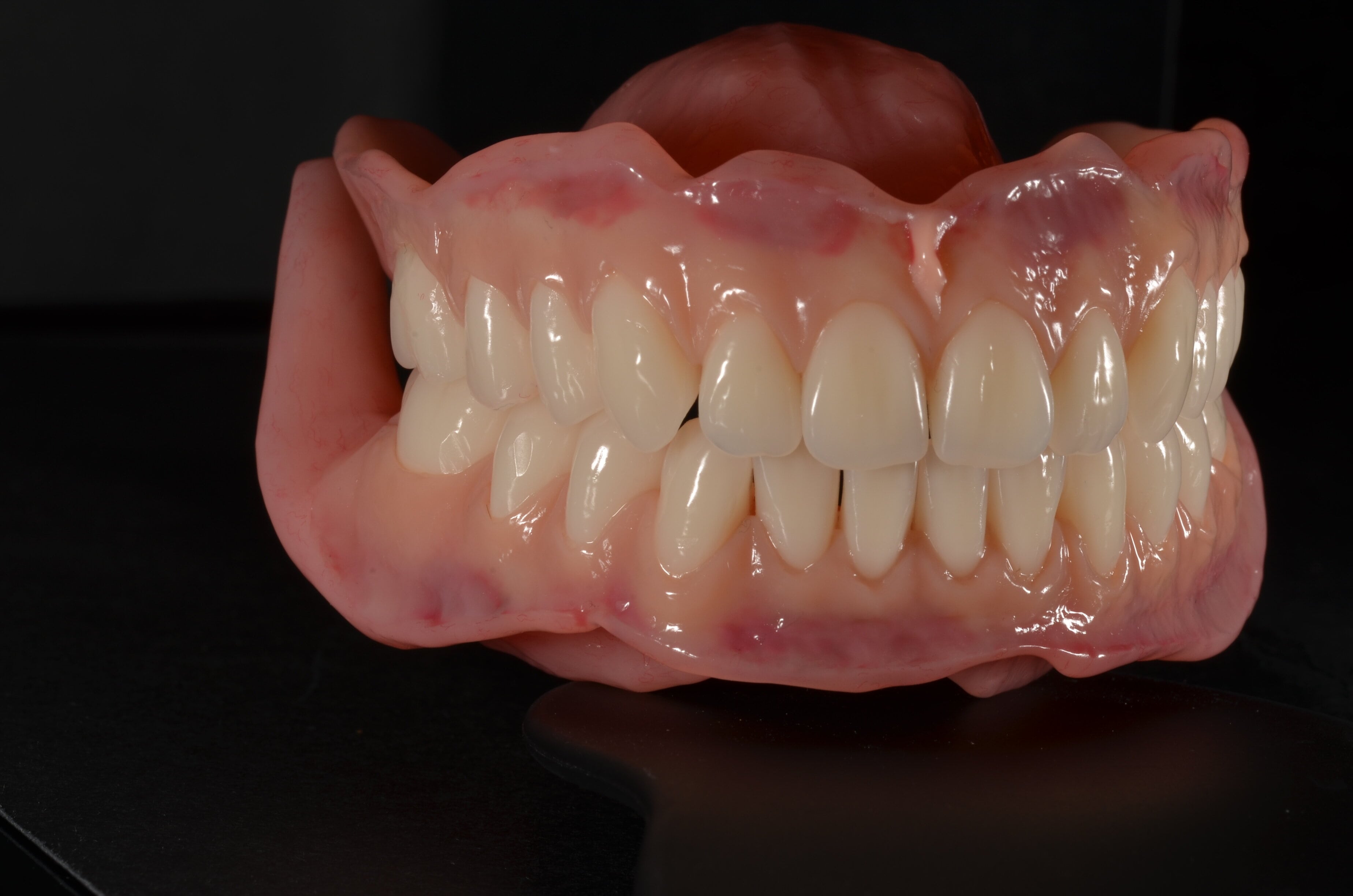 custom dentures designed at charisma clinic