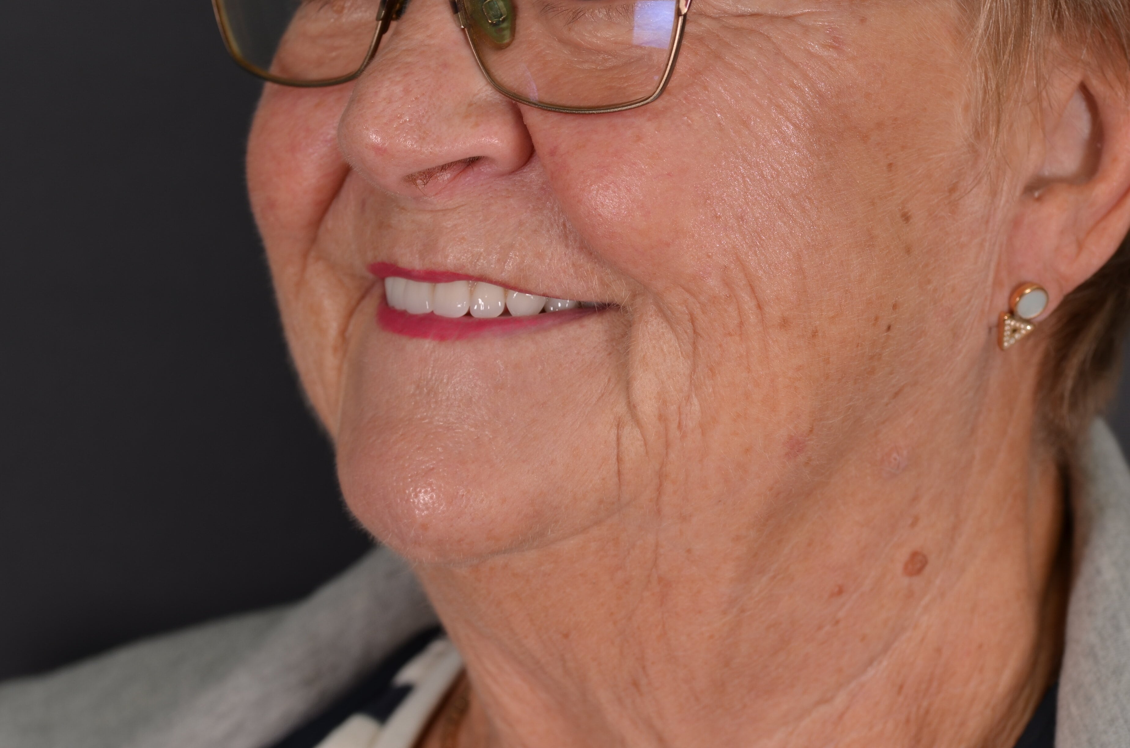 Lindas custom fitted dentures