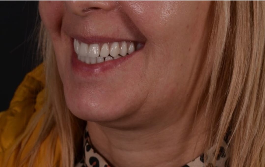 Lancashire patient after all on four dental implants