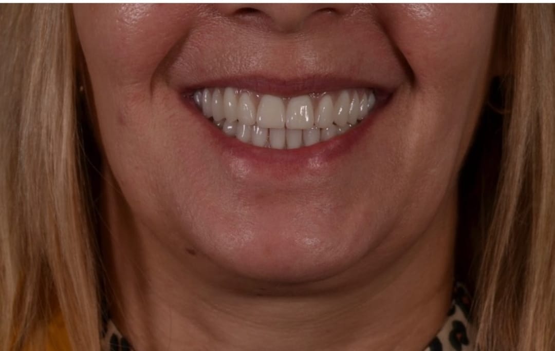 Patient after Same day teeth in Burnley