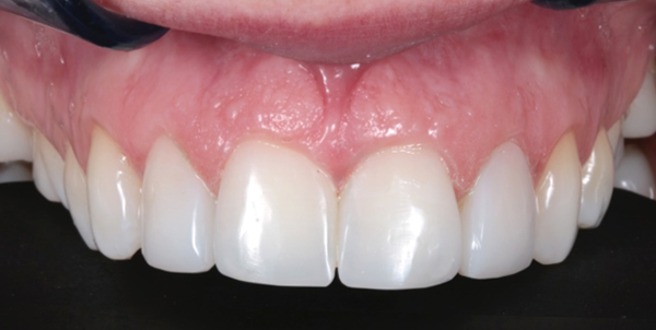 After composite bonding teeth near me case study