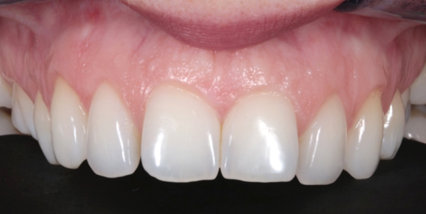 Before Patient composite bonding case study