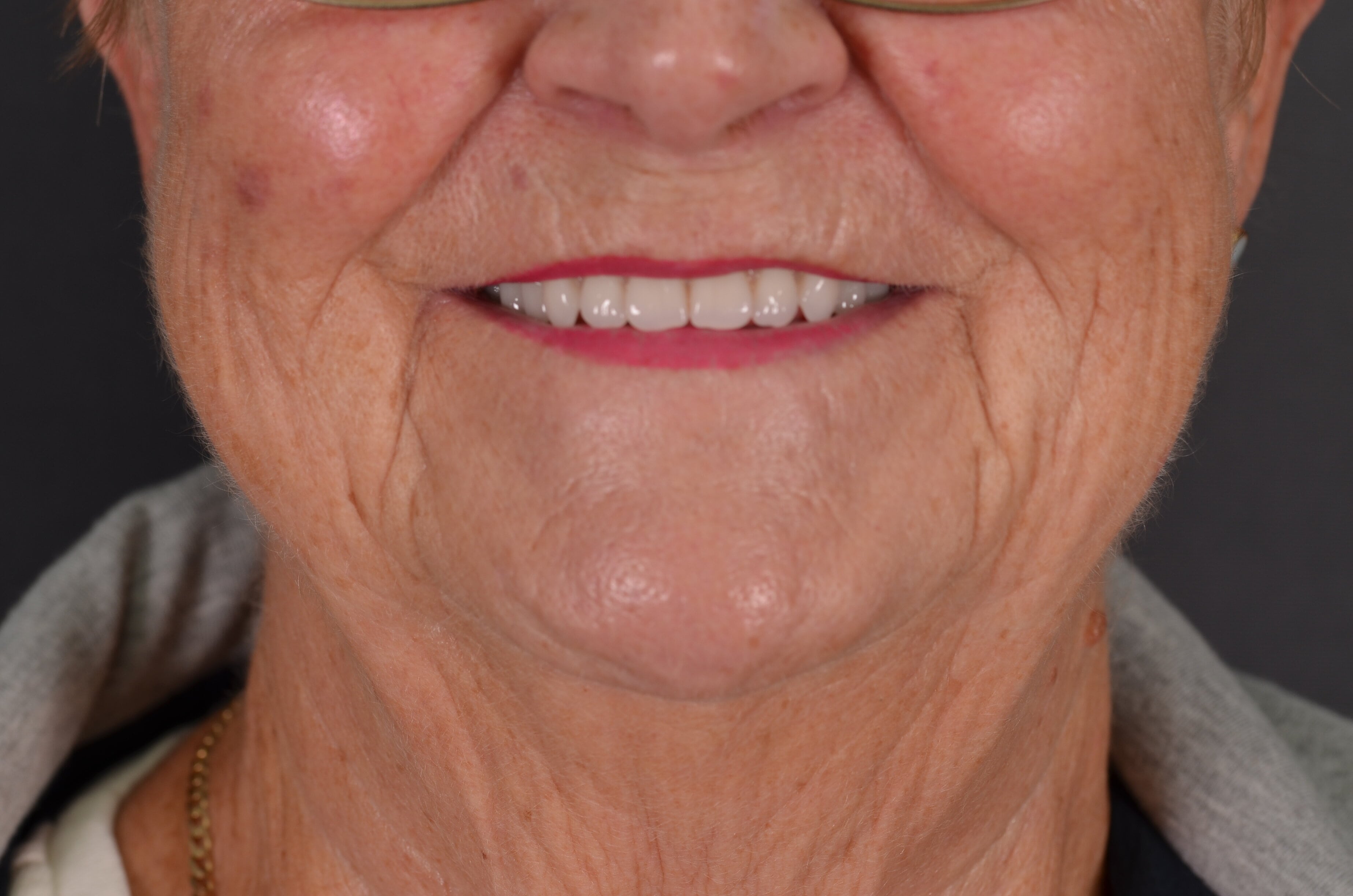 Lindas custom fitted dentures