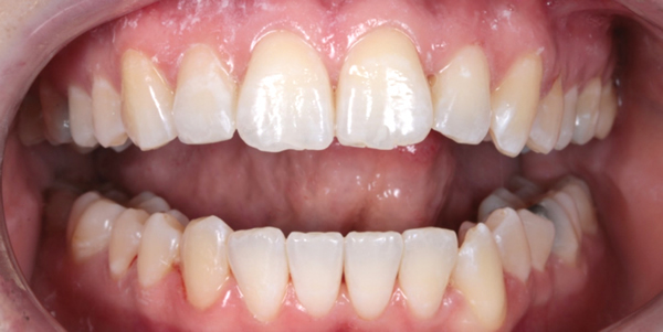 Patient after Invisalign braces near me