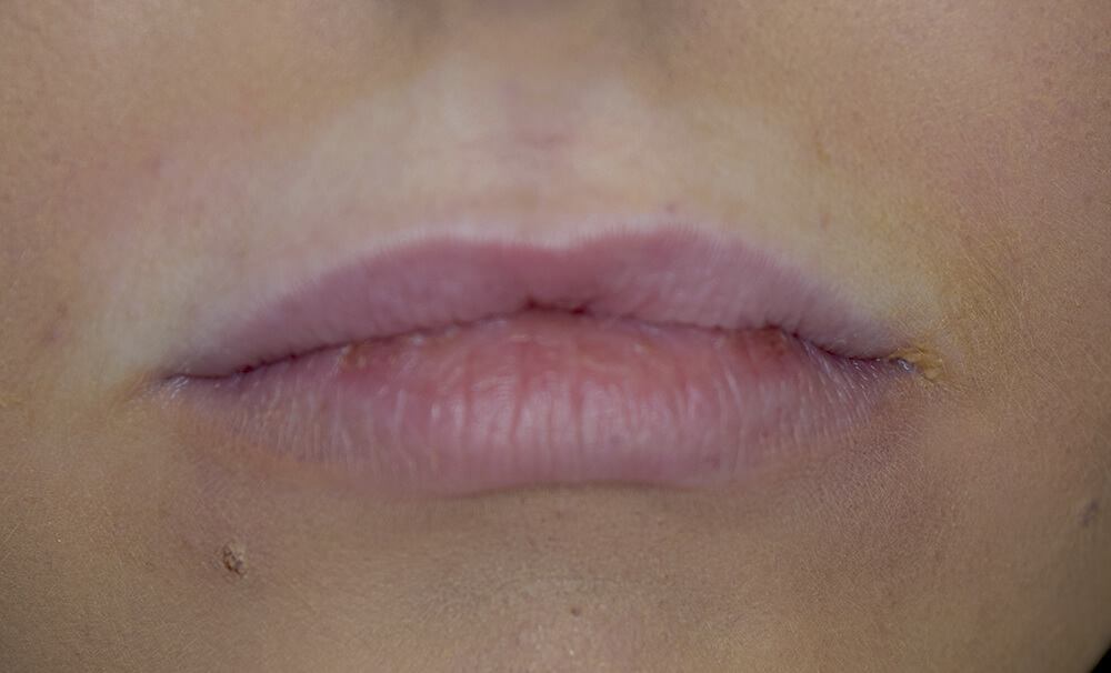 Before lip filler in Burnley