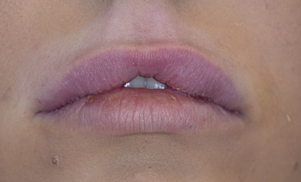 After lip filler in Burnley