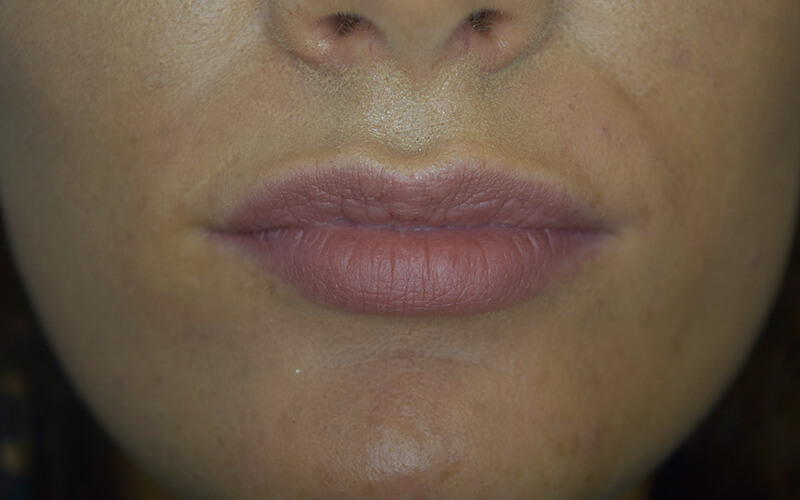 Lips enhancements near me