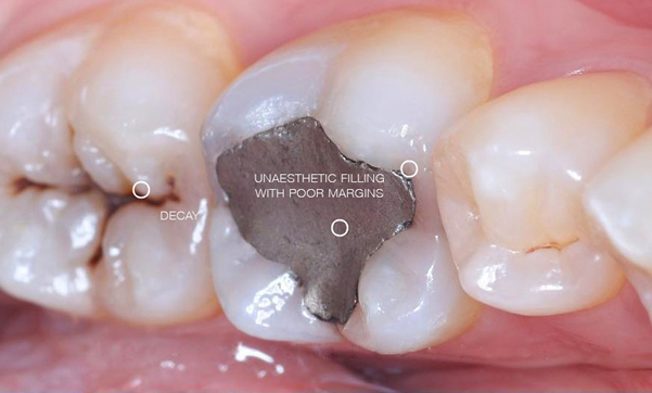 Before white fillings at Charisma clinic in Burnley